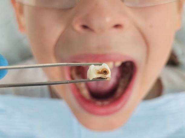 Best Emergency Dentist for Lost Fillings or Crowns in Birchwood Lakes, PA